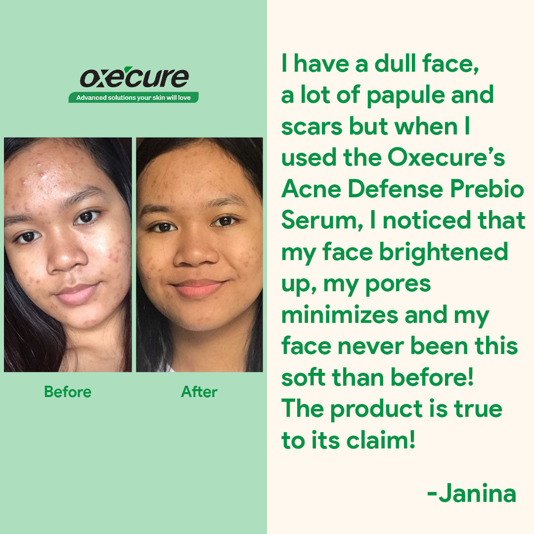 OXECURE Acne Defense Prebio Serum 5ml