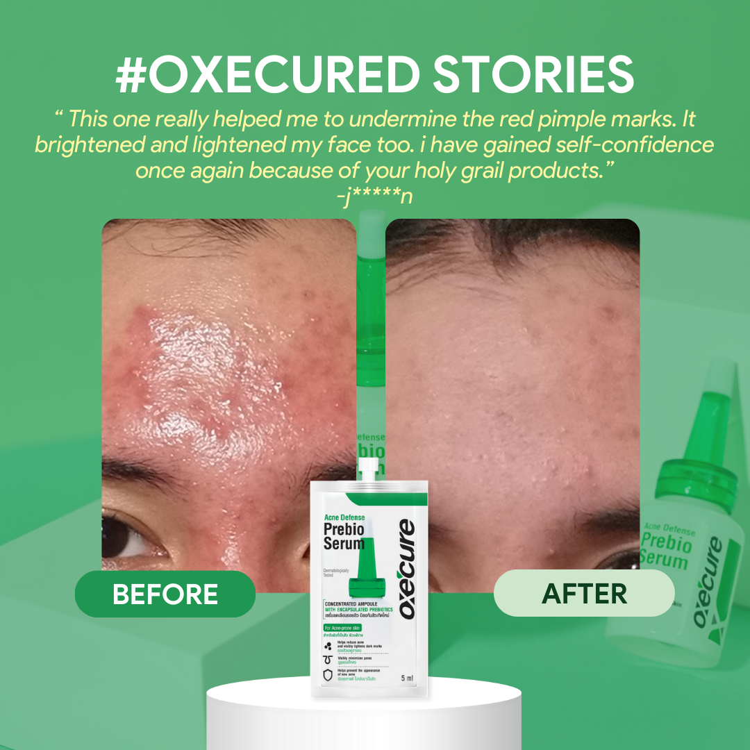 OXECURE Acne Defense Prebio Serum 5ml